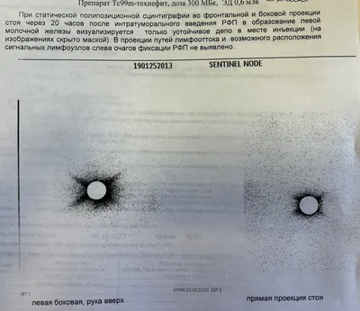 Некоторые особенности изменений подмышечных лимфатических узлов без  метастазов после химиотерапии при раке молочной железы – тема научной  статьи по клинической медицине читайте бесплатно текст  научно-исследовательской работы в электронной библиотеке ...