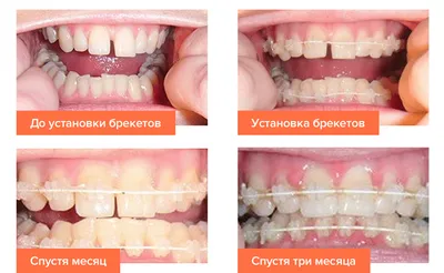 Ортодонтическое лечение на брекетах WIN с удалением зубов
