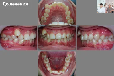 Лингвальные брекеты - Сити Дент
