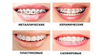 Металлические брекеты. Лечение металлическими брекетами