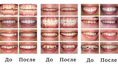 Лингвальные брекеты - Сити Дент