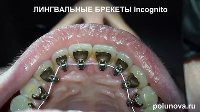 Лингвальные (невидимые) брекеты в Виннице. Цены клиник, отзывы, форум