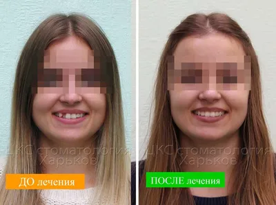 Керамические Брекеты Цена Киев На Зубы Отзывы ЛюмиДент
