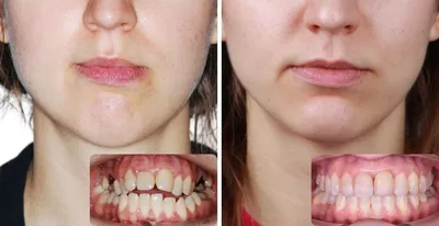 Металлические брекеты - Dental Practice