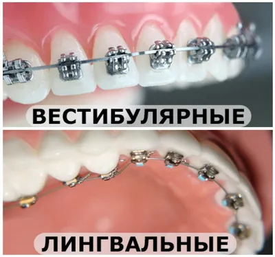 Лечение кривых зубов. Керамические и металлические брекеты в действии