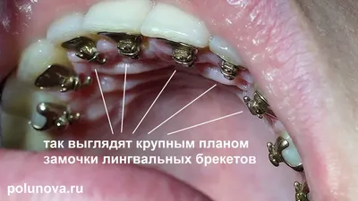 Брекеты на зубы – ставить или нет? Ответы на самые распространенные вопросы.