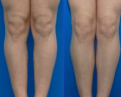 Липосакция ног фото до и после