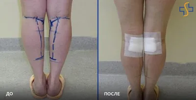 Липосакция ног фото до и после