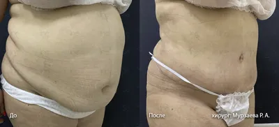 Лазерная липосакция - фото до и после операции