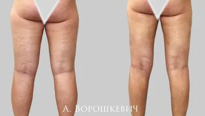 ᐅ Липофилинг ног в Киеве ᐊ Цены и отзывы на липофилинг голеней и бедер в  клинике Аура