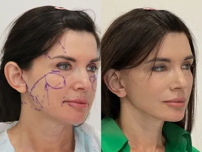 Липофилинг лица до и после, реабилитация и противопоказания — Украинская  академия пластической хирургии