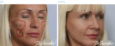Пластическая хирургия -Пластика лица -Липофилинг лица -Фотогалерея До и  После
