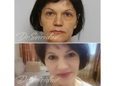 Фото до и после - Липофилинг лица