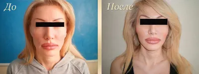 Коррекция формы подбородка | Цена в Москве | Age Clinic