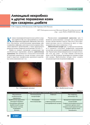 Липоидный некробиоз и метаболический синдром