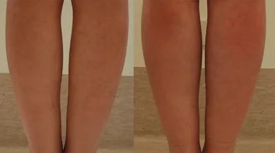 Увеличение голени: фото до и после операции