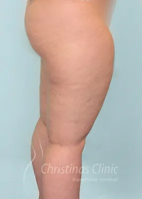 Флебэктомия - удаление вен на ногах: отзывы об операции, фото до и после |  Beauty Insider