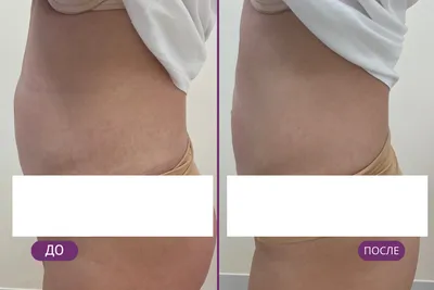 Процедура Zeltiq Coolsculpting – аппаратная липосакция, цены в Москве