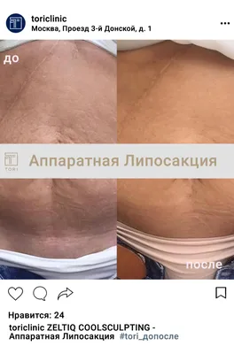 Абдоминопластика или пластика живота - цены, фото до и после