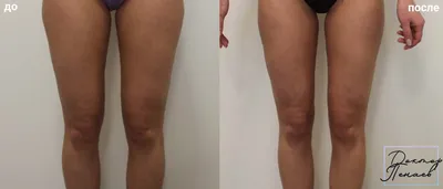 Липосакция ног фото до и после фотографии
