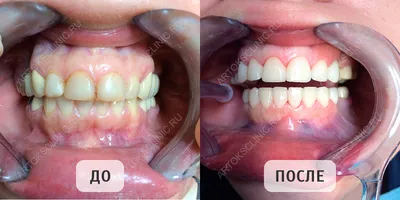 Люминиры на кривые зубы фото до и после фотографии
