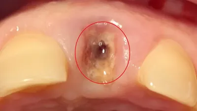 Сухая лунка и альвеолит после удаления зуба - невыполнение рекомендаций  пациентом