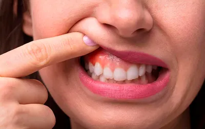 Воспалилась десна после удаления зуба: почему так происходит и что нужно  делать?