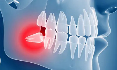 Удаление зуба мудрости: особенности операции, срок заживления, рекомендации  по уходу - блог Аксиома Дентал