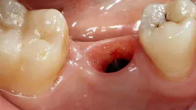 ᐈ Удаление Зуба: Как Предотвратить Осложнения ᐈ Возможные последствия после  удаления зуба