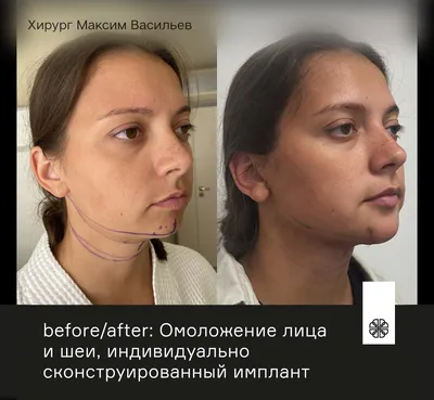 Как выглядит подтяжка нитями в фото До и После - Cosmetic-clinic