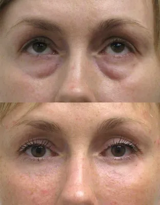 Малярные мешки. Чек-лифтинг (лифтинг средней зоны лица). Фото до и после  операции.