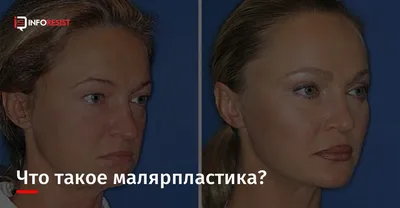 Пластика скул: все, что нужно знать. И даже больше! | Пластик-Клуб - все о  пластике | Дзен