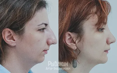 Пластика кончика носа → Фото результатов до и после пластической операции