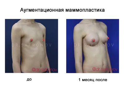 Маммопластика – Аміда