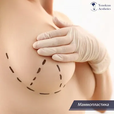 Маммопластика (пластика груди) в Воронеже | Доступные цены на увеличение,  подтяжку, липофилинг грудных желез | Узнать стоимость маммопластики в  клинике «Олимп Здоровья»