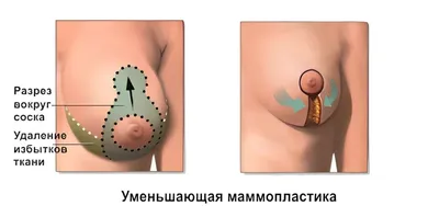 Маммопластика. Увеличение груди.
