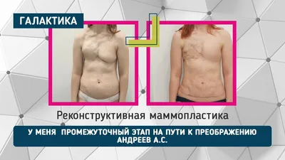 Аугментационная маммопластика – тема научной статьи по клинической медицине  читайте бесплатно текст научно-исследовательской работы в электронной  библиотеке КиберЛенинка