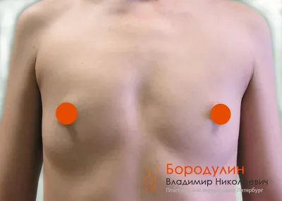 Маммопластика, увеличение груди в Краснодаре | Клиника \"Люди\"