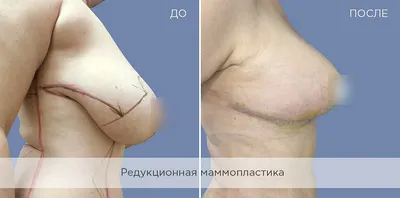 Выгодное предложение: маммопластика по специальным ценам - Новости