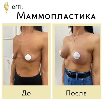 ▷ Маммопластика – Увеличение груди в Киеве ✓ Цены на увеличение груди в МЦ  ADONIS