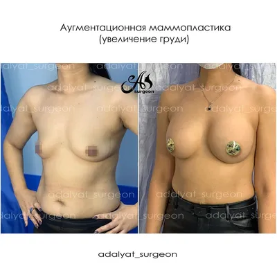 Маммопластика (пластика груди), коррекция формы груди после родов,  стоимость операции, подготовка и реабилитация — Пластический хирург Сергей  Дерновой: консультация в Москве