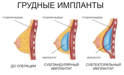 Единственный эффективный способ скорректировать форму груди, избавиться от  врождённого изъяна и устранить возрастные изменения это маммопластика.