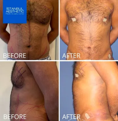 Фото до и после операция при гинекомастии | Bookimed