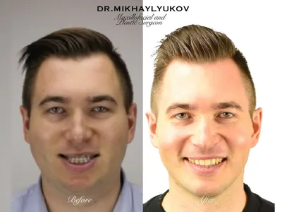 Ортогнатическая хирургия. Фотографии \"до и после\". ⋆ Хирург Владимир  Михайлюков