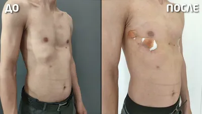 Операция Насса при ассиметричной воронкообразной деформации грудной клетки.  - YouTube