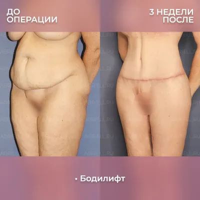 Операция бодилифт: фото до и после