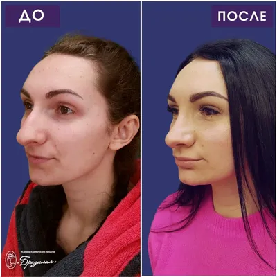 Операция лисий взгляд в Киеве на Печерске - Coolaser Clinic