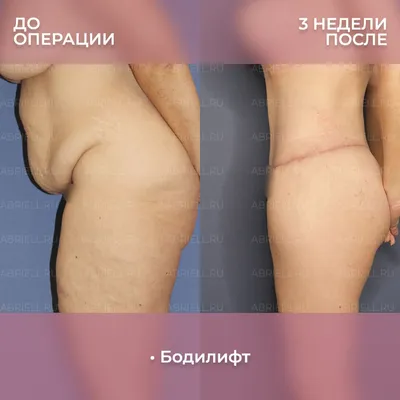 zavertylenko_md - Лапароскопия. Паховая грыжа На фото - внешний вид живота  на следующий день после лапароскопической пластики паховой грыжи у мужчины.  Да, этот пост без страшилок в стиле «до и после». Операция