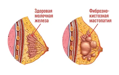 Фиброзно-кистозная мастопатия молочной железы: симптомы, диагностика,  лечение