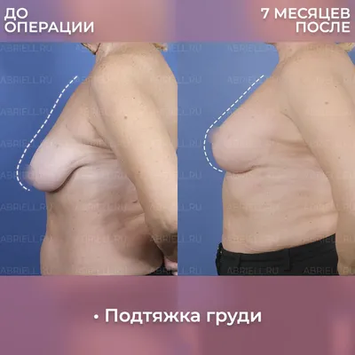 Фото подтяжки груди без имплантов